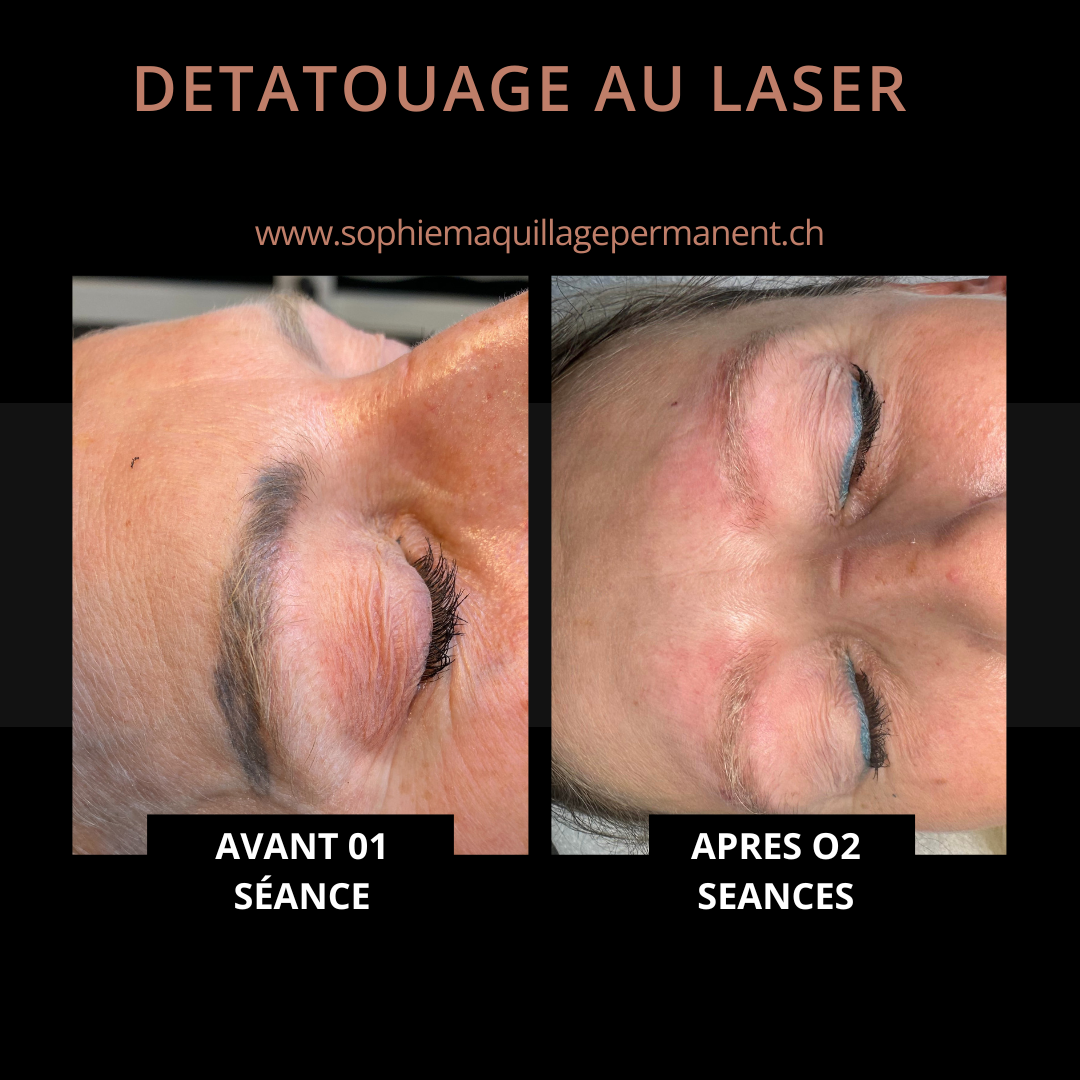detatouage_correction_maquillage_permanent_yverdon_1