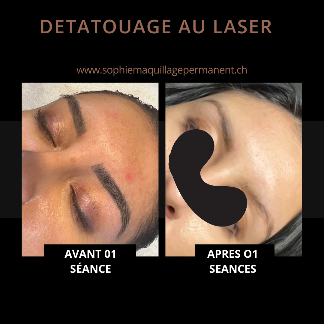 detatouage_correction_maquillage_permanent_yverdon_2
