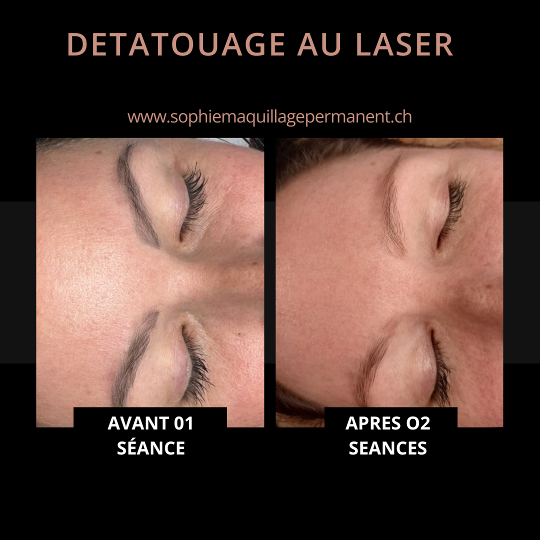 detatouage_correction_maquillage_permanent_yverdon_3
