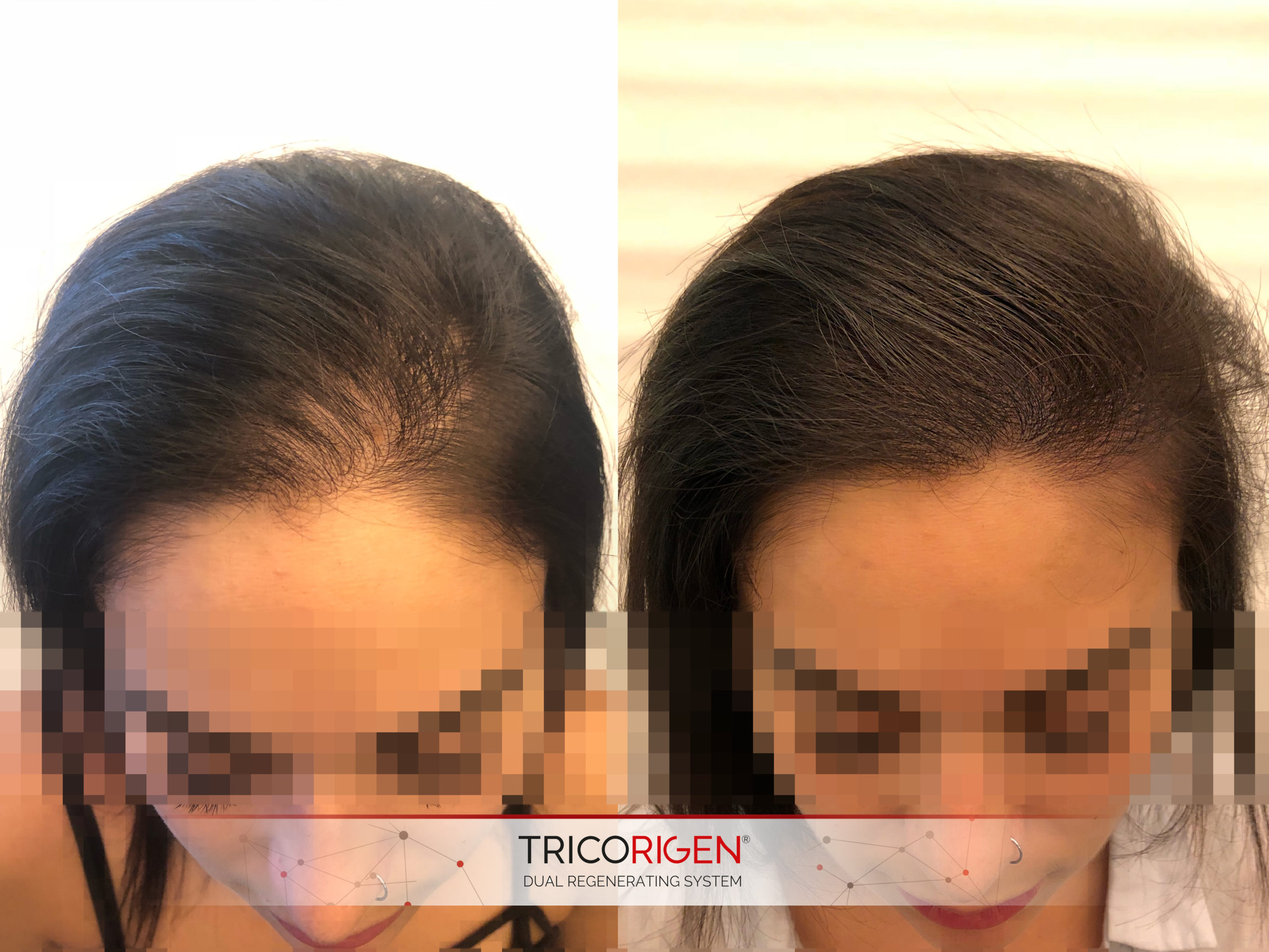 Traitement Repousse des cheveux (Tricorigen)